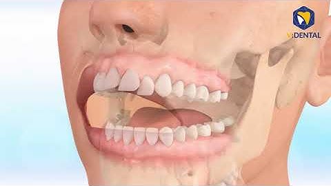 Quy trình Niềng Răng Hô | 3 Bước cơ bản nhất