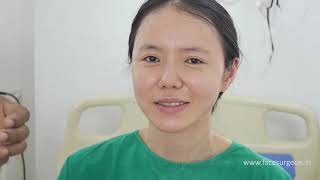 Chinese Girl Plastic Surgery in India - Complete Face Surgery with Instant Results