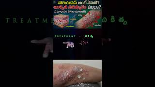 సోరియాసిస్ ఎందుకు వస్తుంది? ఇది అంటువ్యాధా? | What is Psoriasis Causes, Types &amp; Treatment #skincare