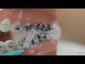 How to use interdental brushes on braces | Evolution Orthodontics