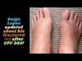 DIEGO LOPES UPDATED ABOUT HIS FRACTURED LEG AFTER UFC 325! #diegolopes #alexandervolkanovski #ufc325