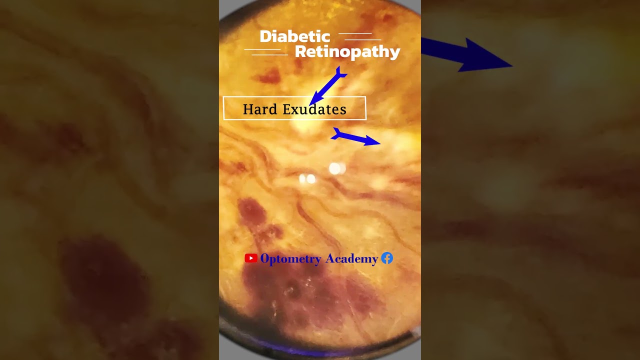 Hard Exudates | Diabetic retinopathy | Fundus Photography | Short Video 434