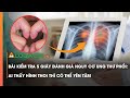 Bài kiểm tra 5 giây đánh giá nguy cơ ung thư phổi