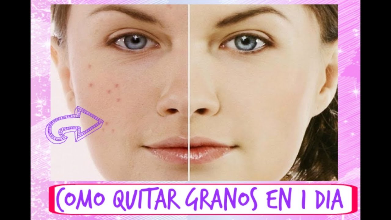 Como quitar granos del rostro en 1 día??,[[Rápido y eficaz]]+Tipsbyaime YouTube