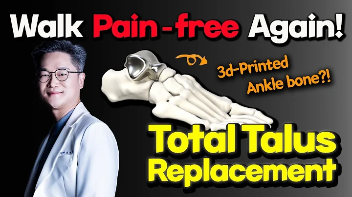 What is Total Talus Replacement? A Life-Changing Ankle Surgery. Ankle Bone Replaced!#avntreatment