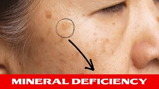 Lack of This Mineral Is Causing Your Age Spots
