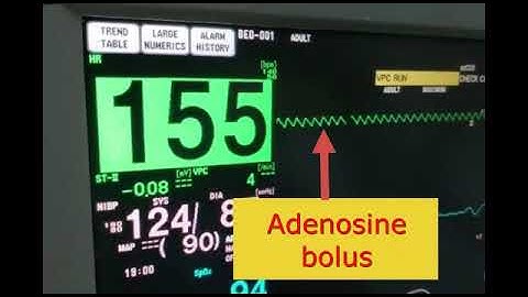 Atrial Flutter with 2:1 conduction