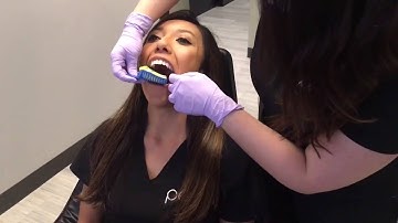 Invisalign: My Experience and Everything You Need to Know (Part 3 of 3)