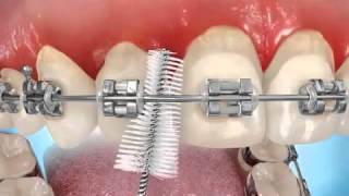 Le brossage des dents est primordial, d'autant plus pour les porteurs  d'appareils orthodontiques