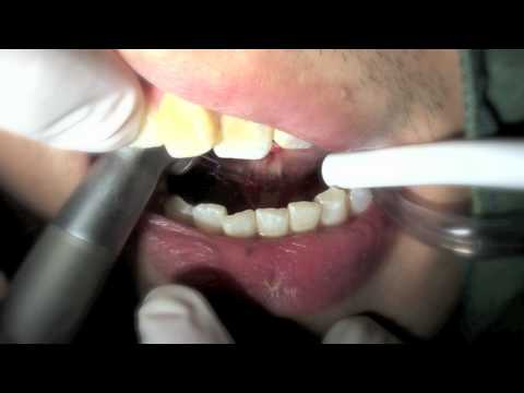 Lingual Frenectomy