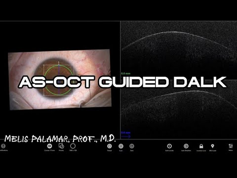AS-OCT guided DALK in keratoconus - YouTube