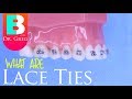 Lace Ties for Braces