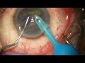 Management of a soft cataract  ns grade 2 microscope lumerat pradip mohanta 24 october 2023