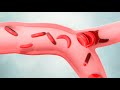 Quiz sobre Anemia Falciforme
