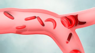 Un tratamiento genético para la anemia falciforme | Video HHMI BioInteractive by biointeractive 2,370 views 8 months ago 5 minutes, 48 seconds