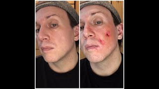 Light Second Degree Burn - SFX Makeup - Out of Kit Demo - Lockdown 2020 Series
