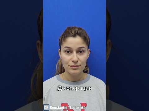 Риносептопластика. В конце