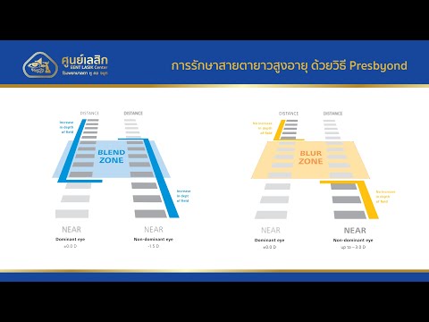 การรักษาสายตายาวสูงอายุ ด้วยวิธี Presbyond