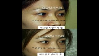 애교살은 본인의 눈매에 어울리는 경우에만 선별적으로 시술을 하여드립니다.