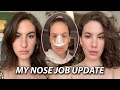 how i *really* feel about my NOSE JOB 6 months later | Jamie Paige