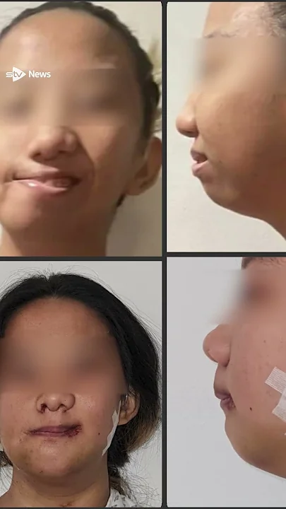 Filipina teen receives major facial reconstruction surgery in ...