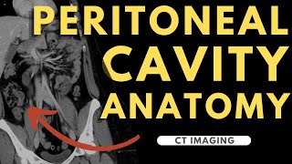 Peritoneal cavity, abdominal organs and spaces | Radiology anatomy part 1 prep | CT abdomen screenshot 3