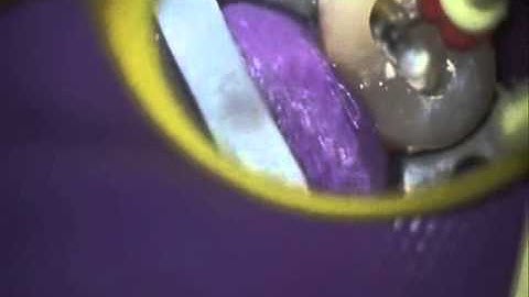 Backfill In A Root Canal Using Seiler Microscope By Elpis Dental