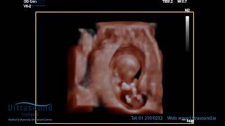 Scan of the Week: 11 Week Early Pregnancy Scan