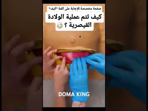 شاهد كيفك تتم عمليه الولاده القيصرية شير كيف كيفية ليك مشاهير شاهد ليكات مشهد متابعه يوتيوب