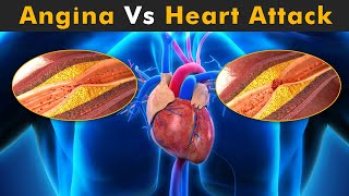 Angina Vs Heart Attack (3D Animation)