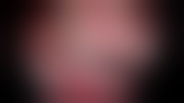 Left superior frontal gyrus (supplementary motor area-SMA)  GBM- radical microsurgery