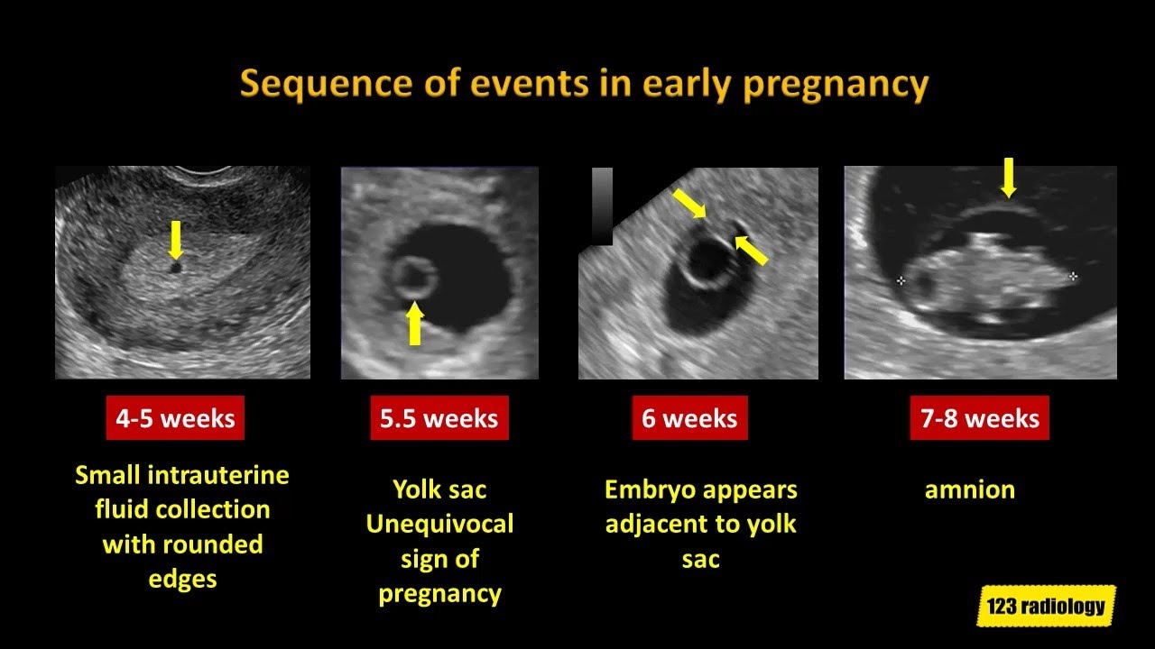 Ultrasound and early pregnancy (Chapter 5) - Early Pregnancy