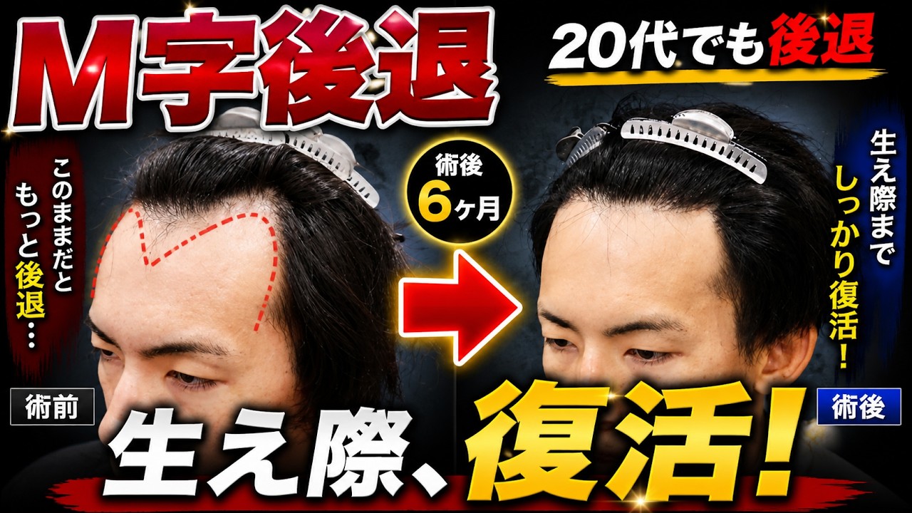 【中古】 植毛完全ガイド 植毛症例 051】20代 男性 生え際1800グラフト - 【公式】自毛植毛専門