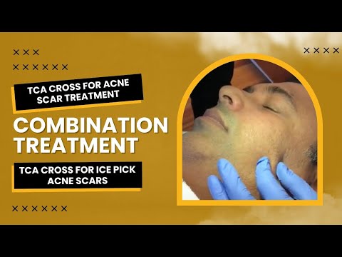 TCA Cross for Acne Scar Treatment | Combination Treatment | TCA cross for Ice Pick Acne Scars