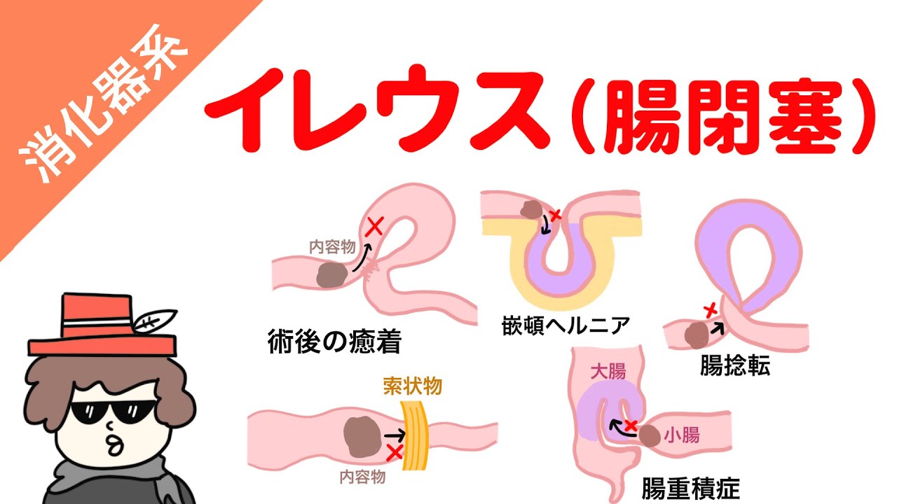 絞扼性ヘルニアはどのように治療されますか?