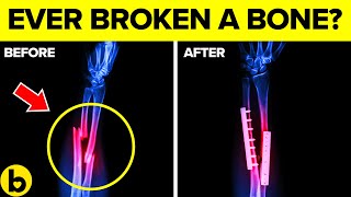 This Is How Your Broken Bones Heals