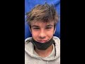 Septoplasty/Endoscopic Sinus Surgery in a 16 Year old 3 days ago and doing well