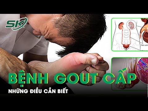 Video: 3 cách để nhận biết các triệu chứng bệnh gút