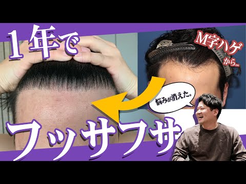 自毛植毛】M字ハゲの悩みが解消！手術から1年が経過した30代男性の現在