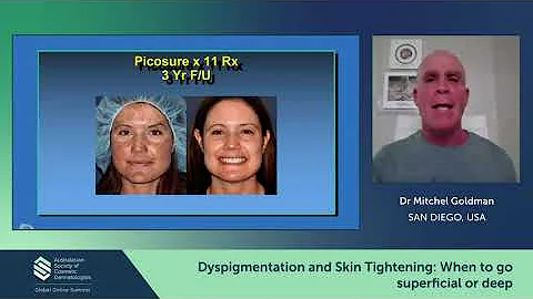 How Laser Dermatology Can Treat Dyspigmentation or Tighten Loose Skin | Dr. Mitchel Goldman