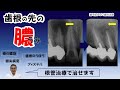 歯根の先の病変:根尖病変、歯根のうほう、フィステル、アブセス、根の先の膿袋、などと歯科医によって言い方は違っていますが、臨床的には同じ病態を示しているようです。これらの病変は根管治療で治します。