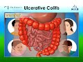 Ulcerative Colitis (अल्सरेटिव कोलाइटिस) क्या है? जानिए  कारण, लक्षण और साधनों का वर्णन | Lybrate