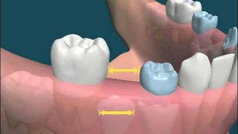 Dental Video of Early Loss of primary Teeth