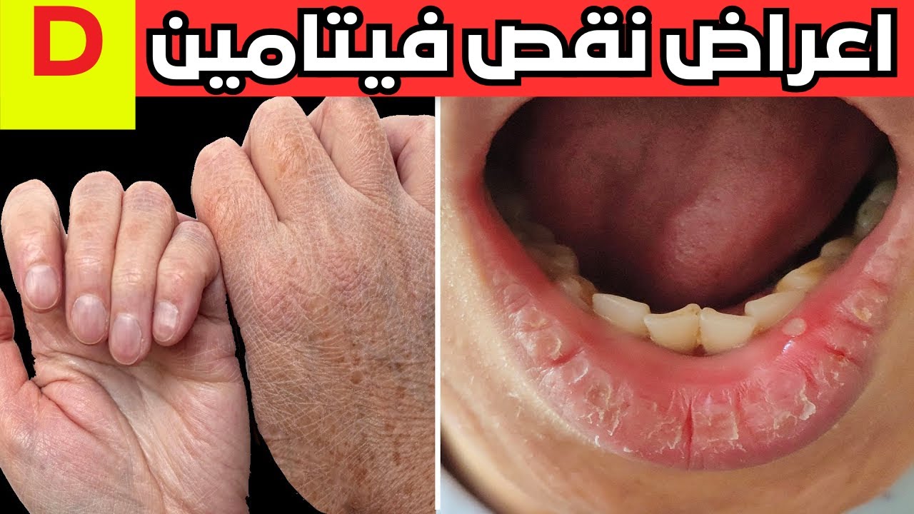 10 أعراض غريبة لنقص فيتامين D (يجب أن تعرفها)_ اعراض اعراض نقص فيتامبنD   _ الوقاية من الامراض