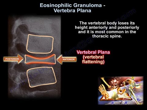 ቪዲዮ: Eosinophilic Granuloma በድመቶች ውስጥ-በቤት ውስጥ ምልክቶች እና ህክምና ፣ የእንስሳት ሐኪሞች መከላከል እና ምክሮች