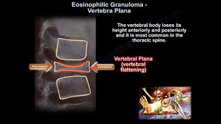 Eosinophilic Granuloma Vertebral Plana - Everything You Need To Know - Dr. Nabil Ebraheim