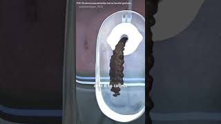 How A Colostomy Bag Works (3D Animation) #doctor #nosereshape #surgeryday #anatomy #sugery #science