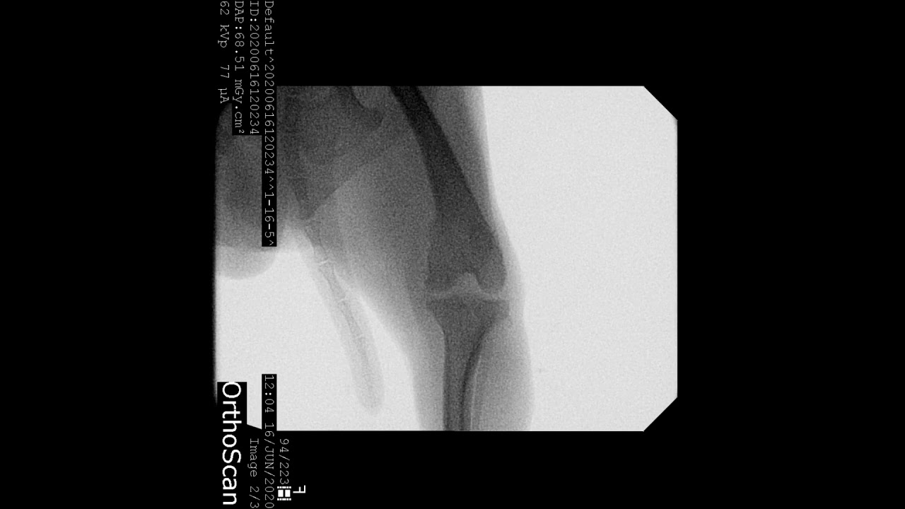 A dog's patella (kneecap) is dislocated inward due to limb extension