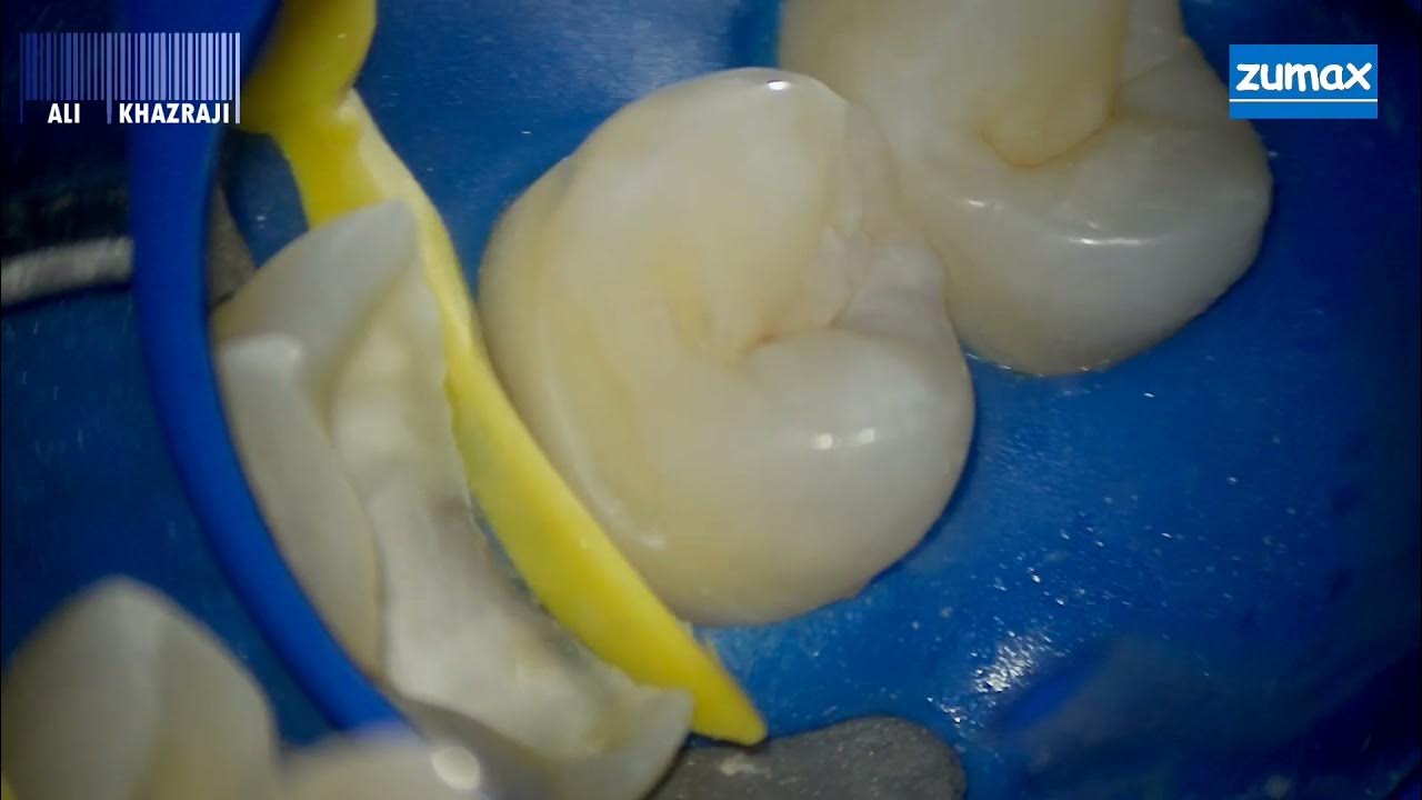 endodontic treatment for long upper first molar = 27 mm... with Snow