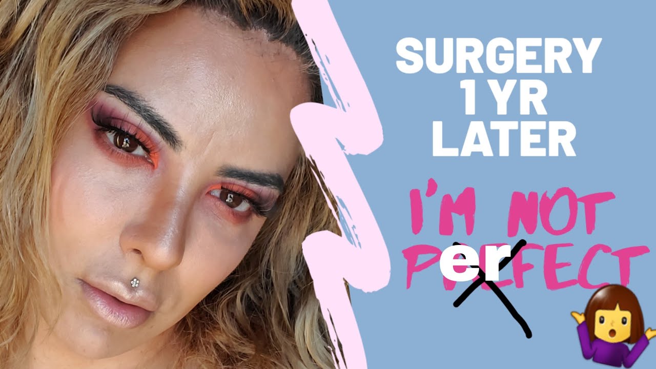 1 YR Jaw Surgery// FFS// Facial Feminization Surgery YouTube